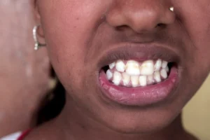 The Silent Crippler: The Growing Crisis of Fluoride Contamination in Rural Assam