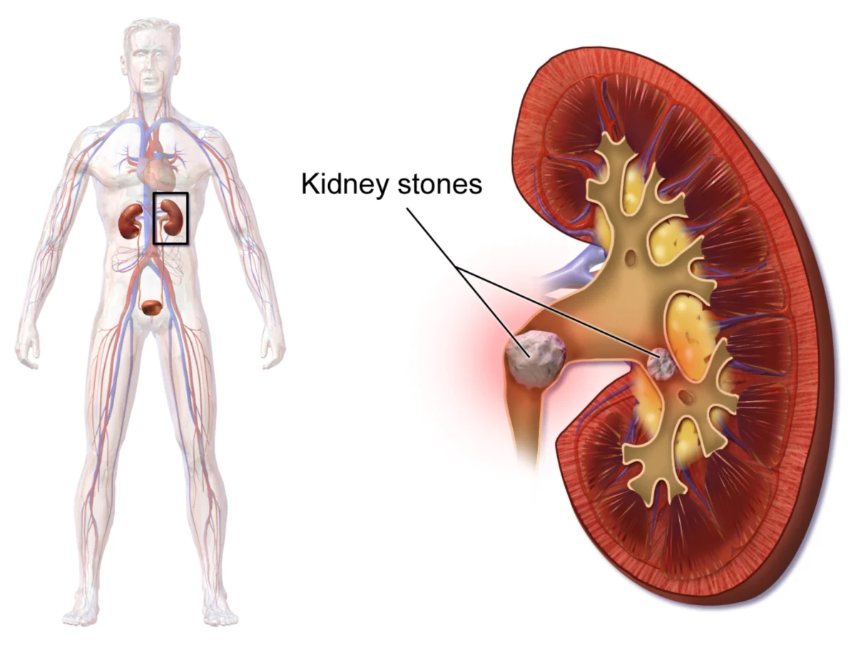 Summer’s Scorching Grip: How Rising Temperatures Threaten Kidney Health and What You Can Do